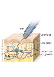 Insulin_haut